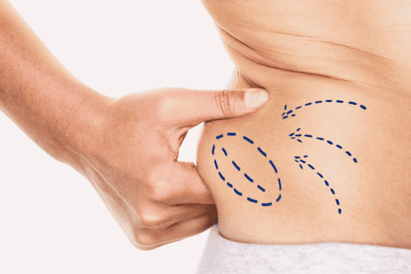 Liposuction Stomach Costs: A Comprehensive Guide 2023